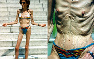 Fetichismos: Mujeres venosas